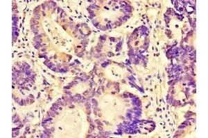 Immunohistochemistry of paraffin-embedded human colon cancer using ABIN7165414 at dilution of 1:100 (FAM151B antibody  (AA 1-276))