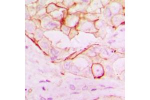 Immunohistochemical analysis of RNF144A staining in human breast cancer formalin fixed paraffin embedded tissue section. (RNF144A antibody  (Center))