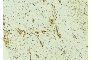 ABIN6276929 at 1/100 staining Human breast cancer tissue by IHC-P. (DKC1 antibody  (Internal Region))