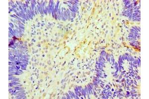 Immunohistochemistry of paraffin-embedded human ovarian cancer using ABIN7153892 at dilution of 1:100 (GCKR antibody  (AA 1-625))