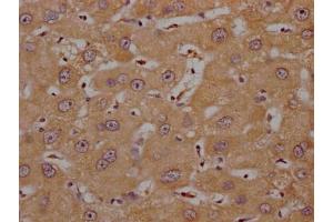 IHC image of ABIN7139992 diluted at 1:200 and staining in paraffin-embedded human liver cancer performed on a Leica BondTM system. (OR4C15 antibody  (AA 258-268))