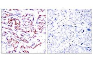 Immunohistochemical analysis of paraffin-embedded human breast carcinoma tissue using ATF2(Phospho-Ser112 or 94) Antibody(left) or the same antibody preincubated with blocking peptide(right). (ATF2 antibody  (pSer112))