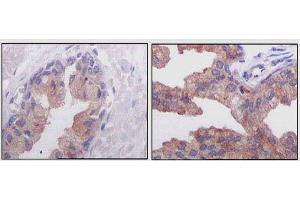 Immunohistochemical analysis of paraffin-embedded human normal prostate tissues (left) and prostate adenocarcinoma tissues (right), showing cytoplasmic localization using AMACR mouse mAb with DAB staining.