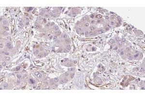 ABIN6273934 at 1/100 staining Human liver cancer tissue by IHC-P. (GPR33 antibody  (Internal Region))