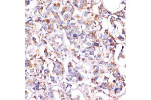 Immunohistochemistry of paraffin-embedded human breast cancer using STOML2 antibody (ABIN6132693, ABIN6148629, ABIN6148630 and ABIN6214642) at dilution of 1:100 (40x lens).