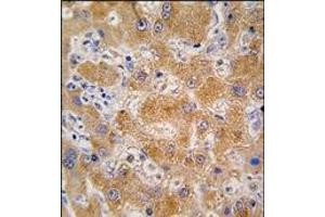 Formalin-fixed and paraffin-embedded human hepatocarcinoma tissue reacted with APOA4 antibody (N-term), which was peroxidase-conjugated to the secondary antibody, followed by DAB staining. (APOA4 antibody  (C-Term, N-Term))