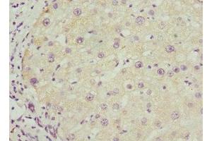 Immunohistochemistry of paraffin-embedded human liver cancer using ABIN7145588 at dilution of 1:100 (BAAT antibody  (AA 309-418))