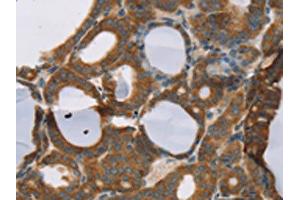 The image on the left is immunohistochemistry of paraffin-embedded Human thyroid cancer tissue using ABIN7192209(RORB Antibody) at dilution 1/30, on the right is treated with synthetic peptide. (RORB antibody)