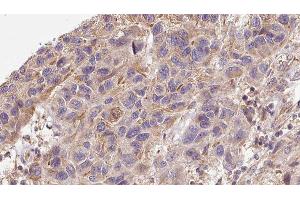 ABIN6276326 at 1/100 staining Human Melanoma tissue by IHC-P.