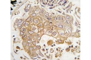 IHC analysis of FFPE human lung carcinoma tissue stained with CYP1A1 antibody (CYP1A1 antibody  (AA 377-405))