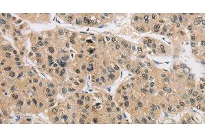 Immunohistochemistry of paraffin-embedded Human liver cancer tissue using AMZ2 Polyclonal Antibody at dilution 1:40 (AMZ2 antibody)