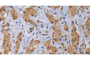 Immunohistochemistry of paraffin-embedded Human breast cancer tissue using CLEC1A Polyclonal Antibody at dilution 1:40