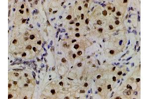 ABIN6267554 at 1/200 staining human renal clear cell carcinoma tissue sections by IHC-P.