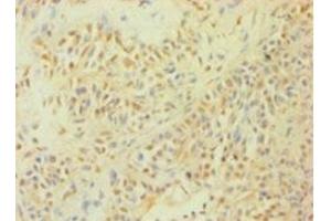 Immunohistochemistry of paraffin-embedded human breast cancer using ABIN7146925 at dilution of 1:100 (Caspase 1 antibody  (AA 120-269))
