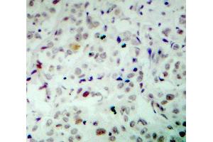 Immunohistochemistry (IHC) image for anti-Retinoblastoma 1 (RB1) (pSer780) antibody (ABIN3020472)