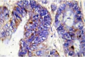Immunohistochemistry (IHC) analyzes of COL4A2 antibody in paraffin-embedded human colon carcinoma tissue. (COL4a2 antibody  (Chain alpha 2))