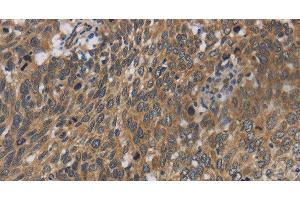 Immunohistochemistry of paraffin-embedded Human cervical cancer using Cytochrome b5 Polyclonal Antibody at dilution of 1:40 (Cytochrome b5 (CYTB5) antibody)