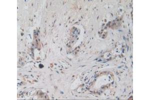 IHC-P analysis of Human Pancreas Cancer Tissue, with DAB staining. (Amphiregulin antibody  (AA 20-100))