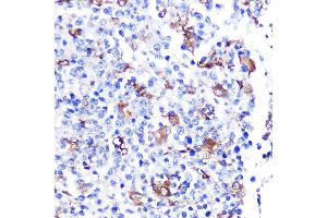 Immunohistochemistry of paraffin-embedded human thyroid cancer using FGF21 Rabbit mAb (ABIN1680154, ABIN3018263, ABIN3018264 and ABIN7101589) at dilution of 1:100 (40x lens).