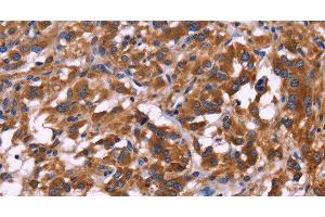 Immunohistochemistry of paraffin-embedded Human thyroid cancer tissue using KIR2DL1/3/4/S4 Polyclonal Antibody at dilution 1:30 (KIR2DL1/3/4/S4 antibody)