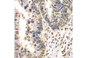 Immunohistochemistry of paraffin-embedded human colon carcinoma using HDAC2 antibody. (HDAC2 antibody  (C-Term))
