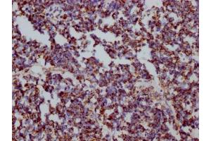 IHC image of ABIN7127551 diluted at 1:100 and staining in paraffin-embedded human liver cancer performed on a Leica BondTM system. (Recombinant HSPD1 antibody)
