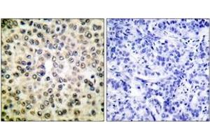 Immunohistochemistry analysis of paraffin-embedded human breast carcinoma tissue, using NF-kappaB p65 (Ab-310) Antibody. (NF-kB p65 antibody  (AA 275-324))