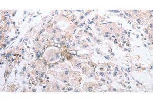 Immunohistochemistry of paraffin-embedded Human lung cancer using MMP11 Polyclonal Antibody at dilution of 1:40 (MMP11 antibody)
