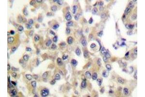 Immunohistochemistry analyzes of Vimentin antibody in paraffin-embedded human breast carcinoma tissue. (Vimentin antibody)