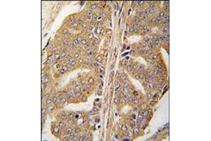 Formalin-fixed and paraffin-embedded human prostata carcinoma tissue reacted with Paxillin Antibody, which was peroxidase-conjugated to the secondary antibody, followed by DAB staining. (Paxillin antibody  (pTyr118))