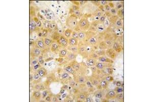 Formalin-fixed and paraffin-embedded human hepatocarcinoma tissue reacted with APH1 antibody (N-term), which was peroxidase-conjugated to the secondary antibody, followed by DAB staining. (APH1A antibody  (N-Term))