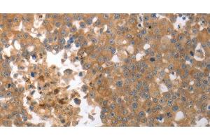 Immunohistochemistry of paraffin-embedded Human breast cancer tissue using MMP27 Polyclonal Antibody at dilution 1:50 (MMP27 antibody)