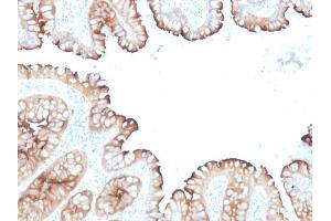 Formalin-fixed, paraffin-embedded human Colon Carcinoma stained with Villin Mouse Monoclonal Antibody (VIL1/1314 + VIL1/2376). (Villin 1 antibody  (AA 179-311))