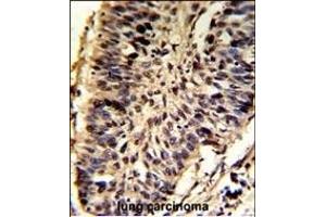 Formalin-fixed and paraffin-embedded human lung carcinoma reacted with SNRPD2 Antibody (N-term), which was peroxidase-conjugated to the secondary antibody, followed by DAB staining. (SNRPD2 antibody  (N-Term))