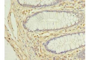 Immunohistochemistry of paraffin-embedded human colon cancer using ABIN7149138 at dilution of 1:100 (COX11 antibody  (AA 115-276))