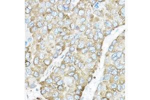 Immunohistochemistry of paraffin-embedded human liver cancer using HSP90B1 Rabbit pAb (ABIN6130434, ABIN6142031, ABIN6142033 and ABIN7101795) at dilution of 1:50 (40x lens). (GRP94 antibody  (AA 550-650))