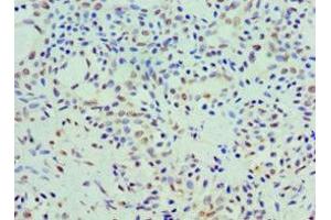 Immunohistochemistry of paraffin-embedded human breast cancer using ABIN7142608 at dilution of 1:100 (Coq7 antibody  (AA 37-217))