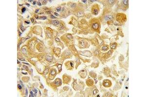 IHC analysis of FFPE human lung carcinoma tissue stained with TLR2 antibody (TLR2 antibody  (AA 212-242))