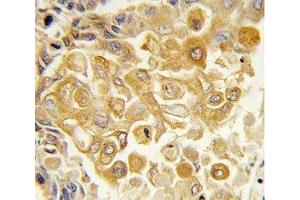 IHC analysis of FFPE human lung carcinoma tissue stained with TLR2 antibody