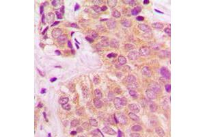 Immunohistochemical analysis of MARK4 staining in human breast cancer formalin fixed paraffin embedded tissue section. (MARK4 antibody  (Center))