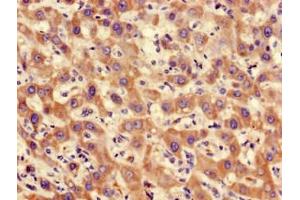 Immunohistochemistry of paraffin-embedded human liver cancer using ABIN7169266 at dilution of 1:100 (PPP2CA antibody  (Catalytic Subunit alpha))