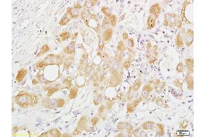 Formalin-fixed and paraffin embedded human liver carcinoma labeled with Anti-Phospho-PRAS40 (Thr246) Polyclonal Antibody, Unconjugated (ABIN744953) at 1:200 followed by conjugation to the secondary antibody and DAB staining (PRAS40 antibody  (pThr246))