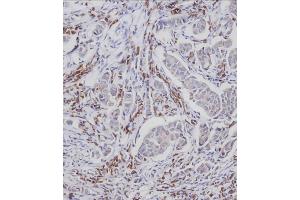 Immunohistochemical analysis of A on paraffin-embedded Human breast carcinoma tissue. (CDC25A antibody  (pSer124))