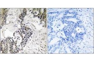 Immunohistochemistry analysis of paraffin-embedded human colon carcinoma, using CDC25C (Phospho-Ser198) Antibody. (CDC25C antibody  (pSer198))