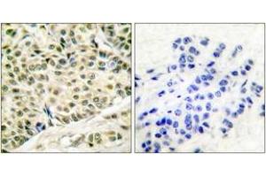 Immunohistochemistry analysis of paraffin-embedded human breast carcinoma tissue, using MCM2 Antibody. (MCM2 antibody  (AA 1-50))