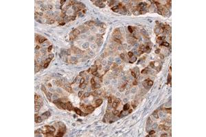 Immunohistochemical staining (Formalin-fixed paraffin-embedded sections) of human breast cancer with HMGCR monoclonal antibody, clone CL0260  shows moderate to strong cytoplasmic immunoreactivity in tumor cells. (HMGCR antibody)