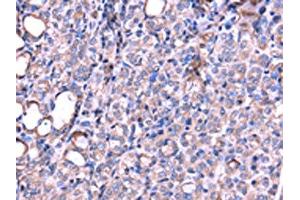 The image on the left is immunohistochemistry of paraffin-embedded Human thyroid cancer tissue using ABIN7131190(SRPK3 Antibody) at dilution 1/20, on the right is treated with fusion protein. (SRPK3 antibody)