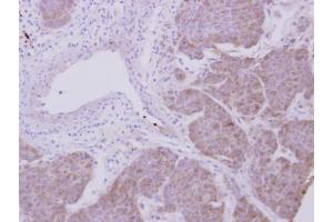 IHC-P Image Immunohistochemical analysis of paraffin-embedded human breast cancer, using Peroxiredoxin 2, antibody at 1:500 dilution. (Peroxiredoxin 2 antibody)