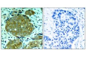 Immunohistochemical analysis of paraffin-embedded human breast carcinoma tissue, using NFκB-p105/p50 (phospho-Ser932) antibody (E011251). (NFKB1 antibody  (pSer932))