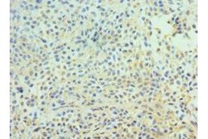 Immunohistochemistry of paraffin-embedded human breast cancer using ABIN7147301 at dilution of 1:100 (CDC16 antibody  (AA 371-620))